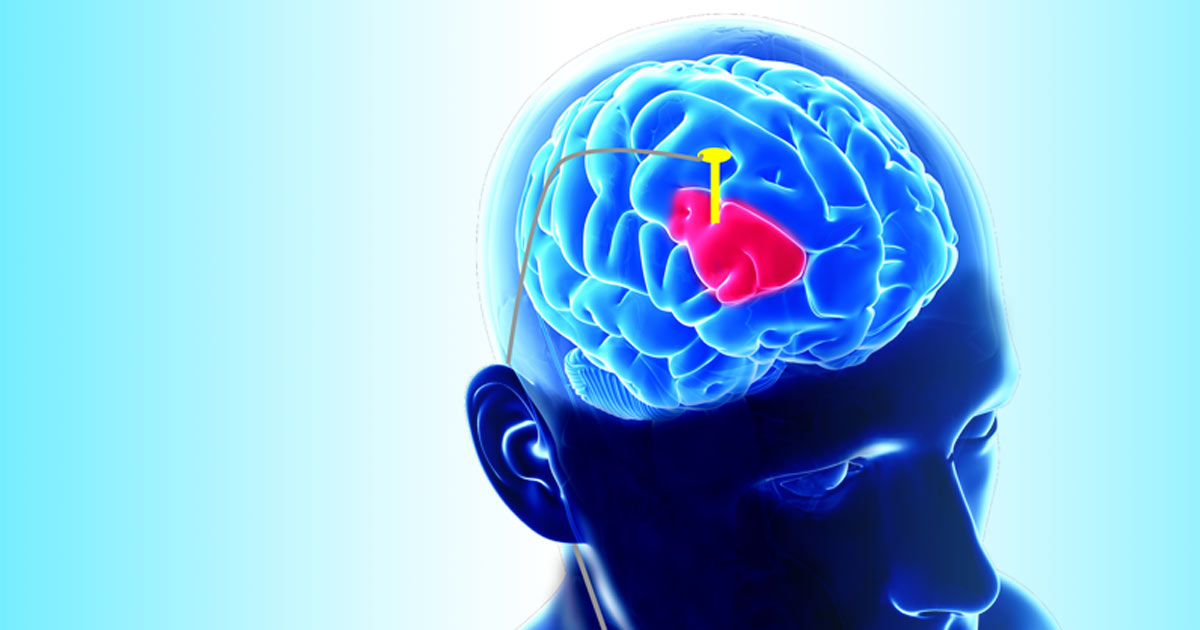 Deep-Brain Stimulation for Parkinson's Disease